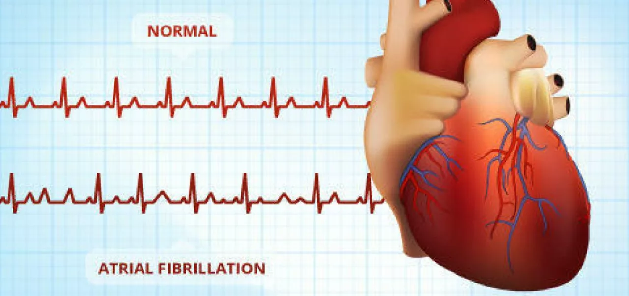 The Role of Apixaban in Reducing Stroke Risk in Patients with Atrial Fibrillation