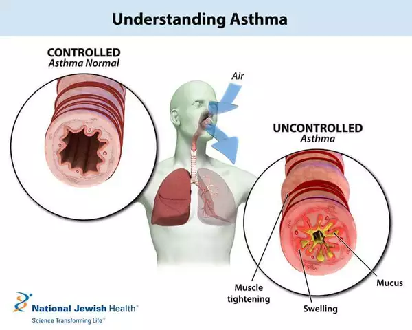 Understanding Asthma Attacks: What You Need to Know